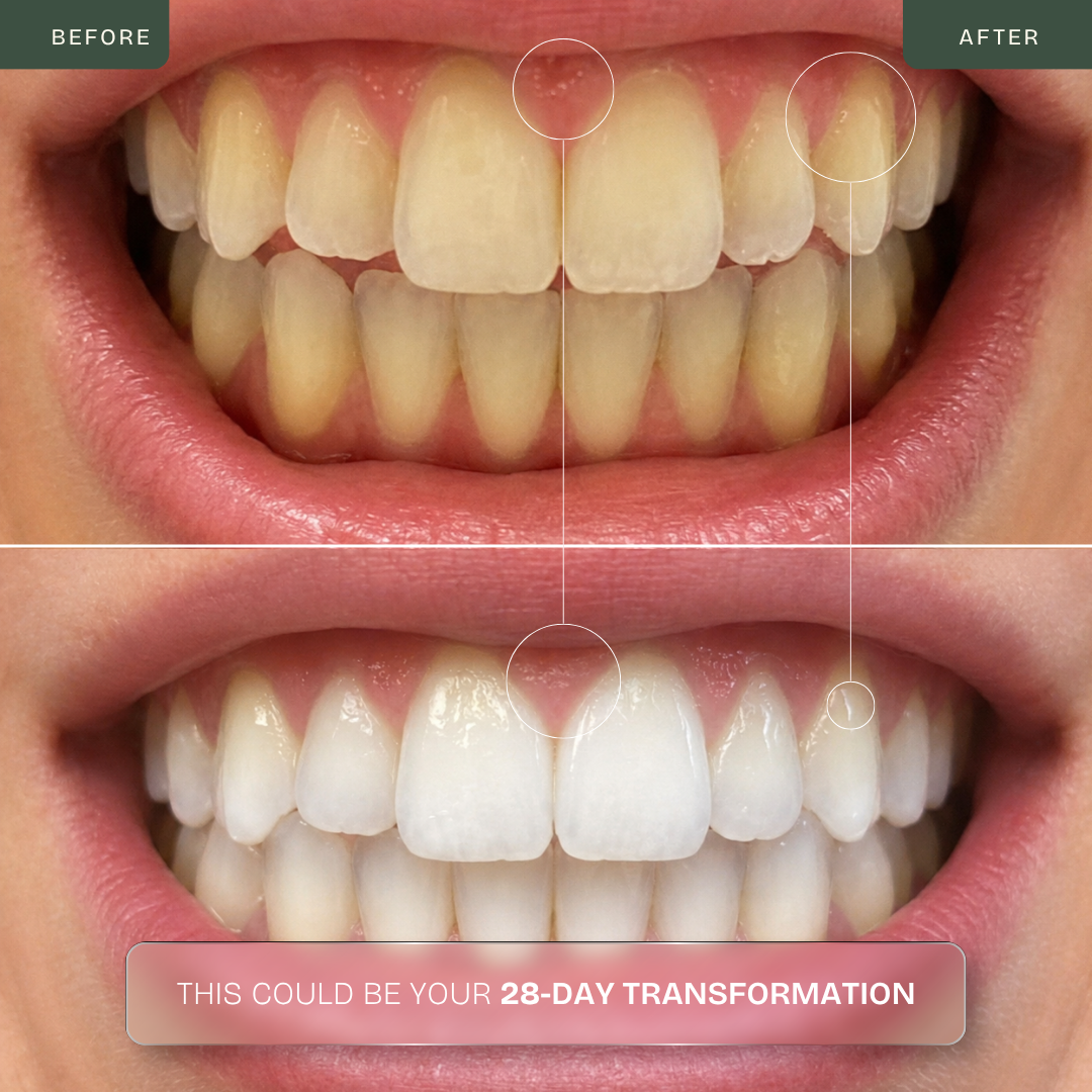 Kit Blanqueamiento Dental Profesional Tecnología Luz Dual