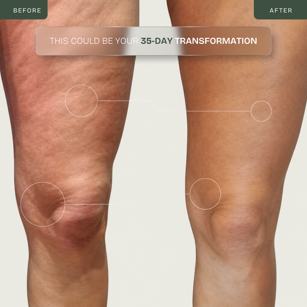 Dispositivo Anticelulitis Radiofrecuencia Tecnología x4