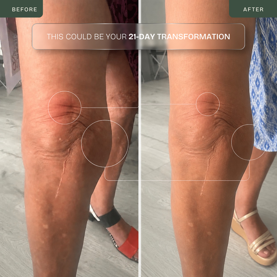 Masajeador de Rodilla Inalámbrico | Alivio del Dolor Articular por Infrarrojos, Calor, Láser y Vibración